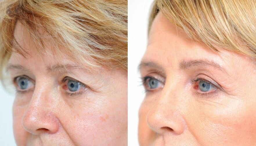 Blépharoplastie avant et après