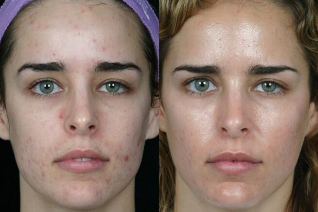 Boucle laser de la peau du visage avant et après
