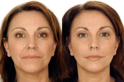 Massage de GPL du visage avant et après