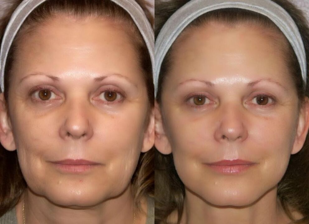 Visage avant et après le rajeunissement du matériel
