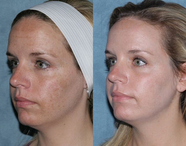 Photo avant et après le rajeunissement fractionnaire du visage
